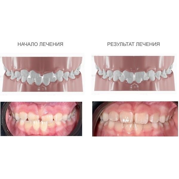 Виртуальный план лечения и результат