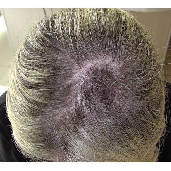 После лечения