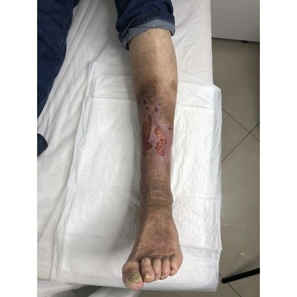 После курса консервативного лечения