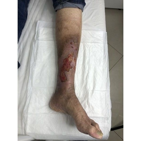 После стабилизации состояния и уменьшения венозного отёка 