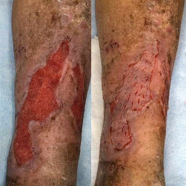 После аутодермопластики 