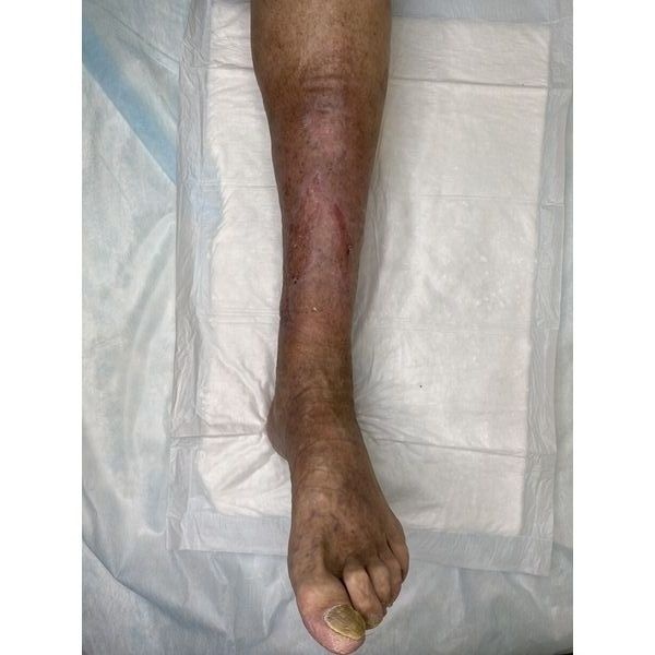 Через 3 месяца после аутодермопластики 