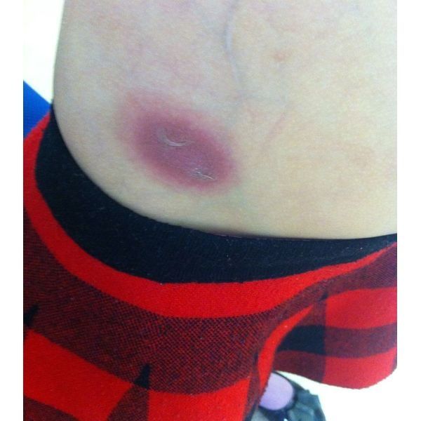 Воспалительный элемент Воспалительный элемент