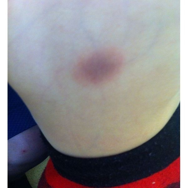 Воспалительный элемент Воспалительный элемент