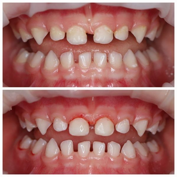 До и после лечения До и после лечения