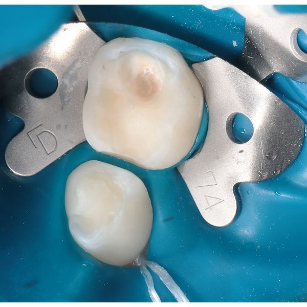 Препарированные зубы