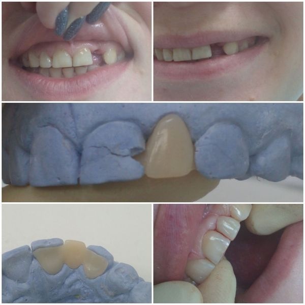 Исходная ситуация и этапы лечения Исходная ситуация и этапы лечения