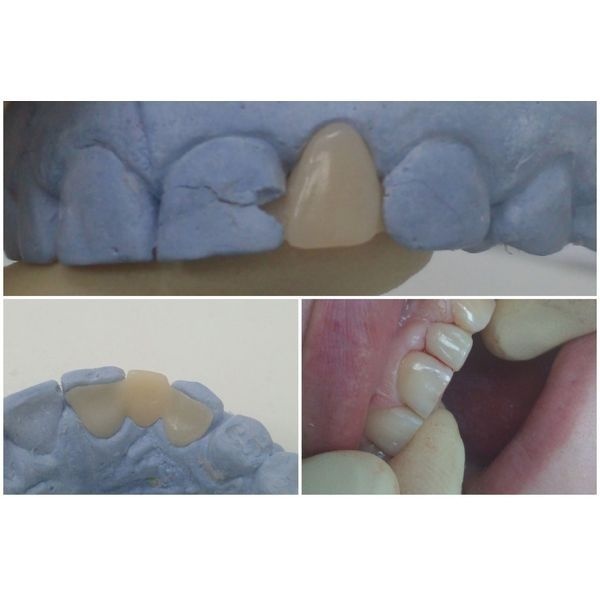 Временный протез Временный протез