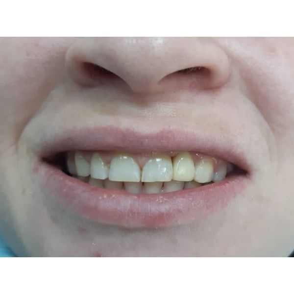 Постоянный протез Постоянный протез