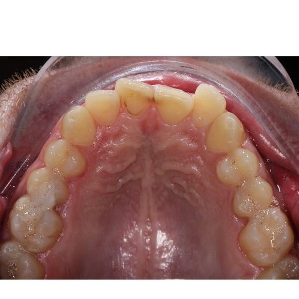 Верхний зубной ряд до лечения