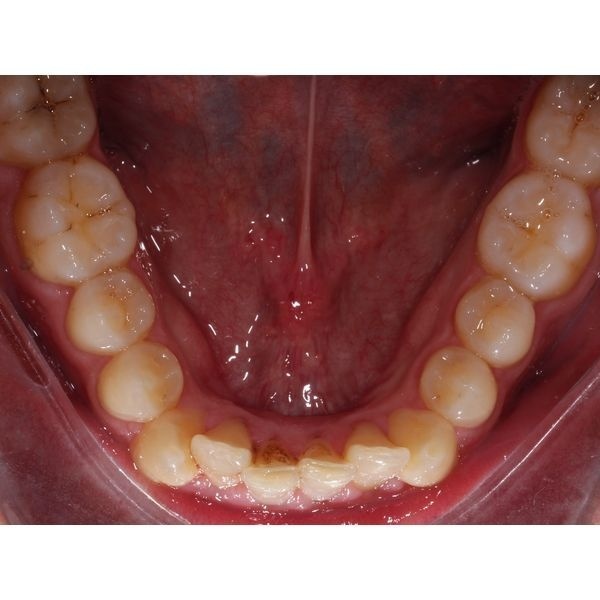 Нижний зубной ряд до лечения