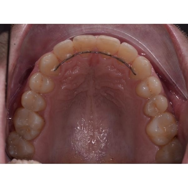 Верхний зубной ряд после лечения