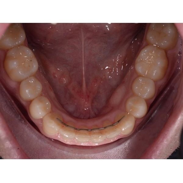 Нижний зубной ряд после лечения