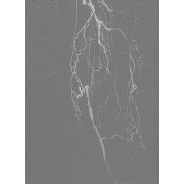 Ангиография до баллонной ангиопластики и установки стента