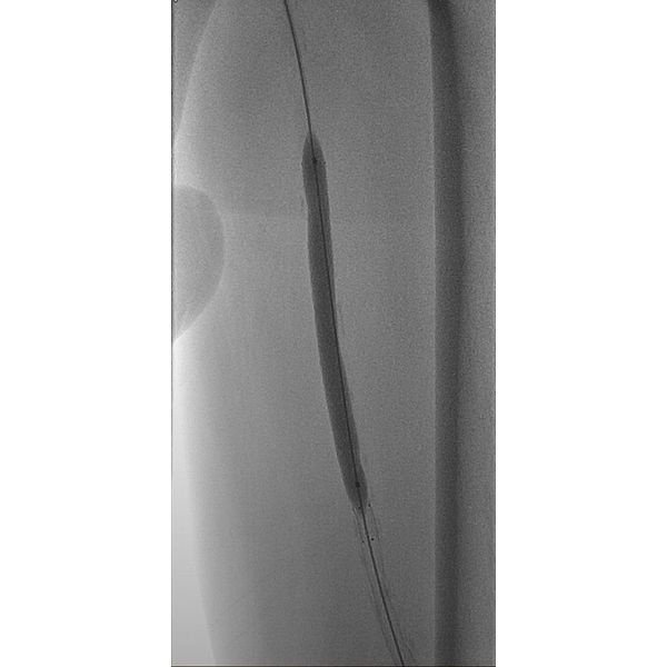 Установка стента в просвет поверхностной бедренной артерии