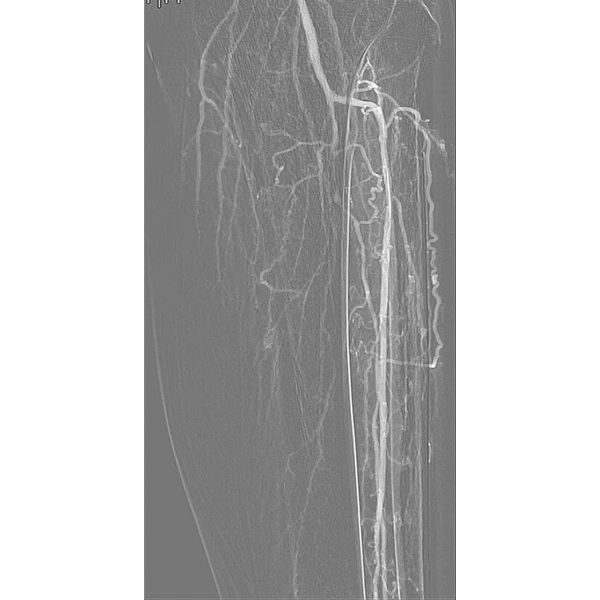 Ангиография после баллонной ангиопластики и установки стента