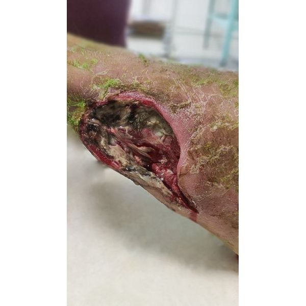 Рана до проведения некрэктомии