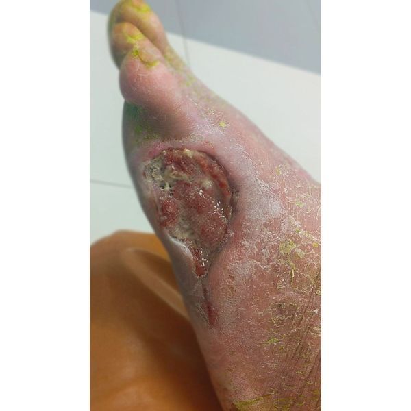 Динамика заживления