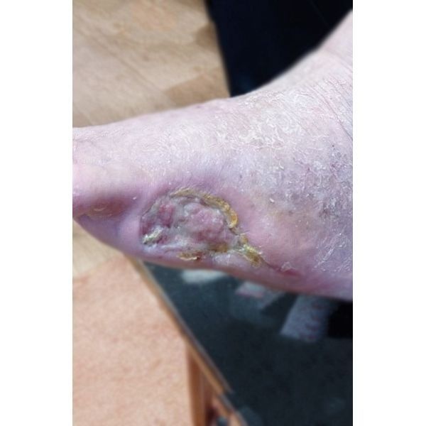 Динамика заживления