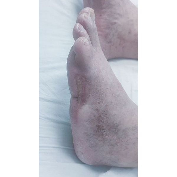 Итоговый результат. Полное заживление