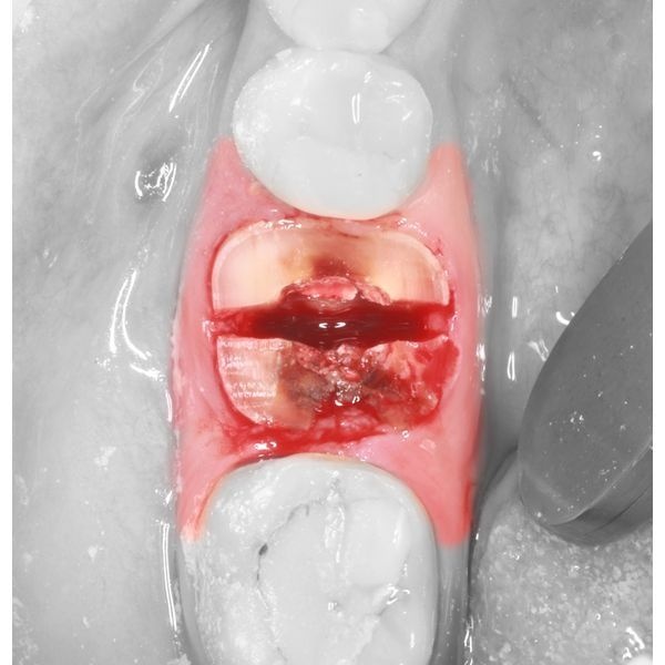 Сегментация зуба