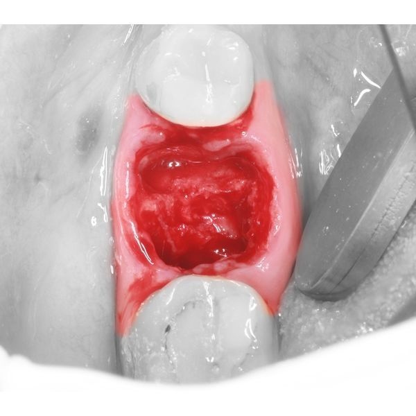 Лунка после удаления