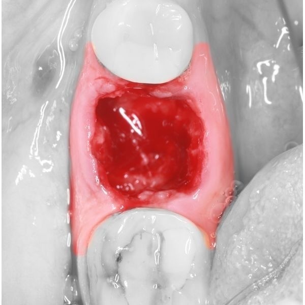Лунка после остеотомии