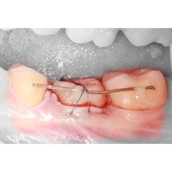 Фиксация зуба 2.8 на месте удалённого зуба 4.6