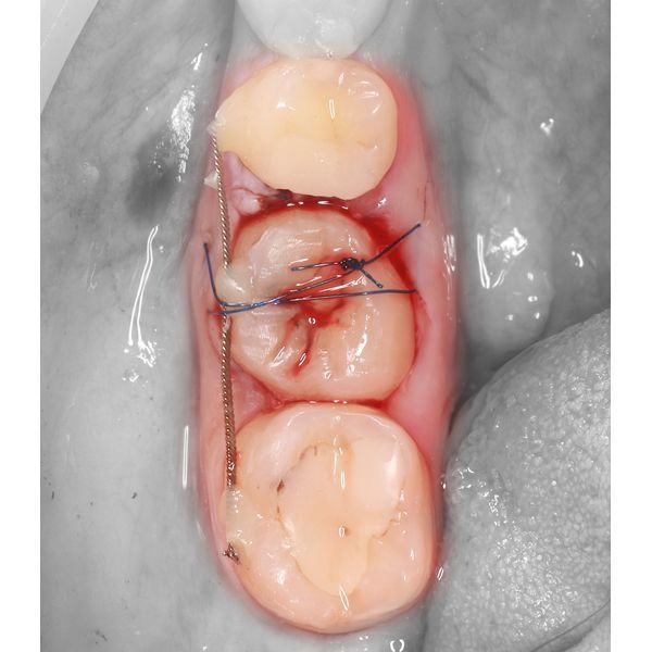 Фиксация зуба 2.8