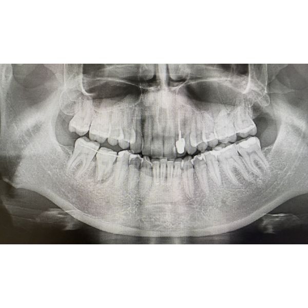 КЛКТ после фиксации зуба