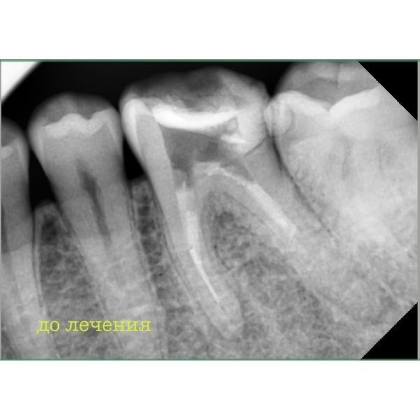 КЛКТ до лечения КЛКТ до лечения