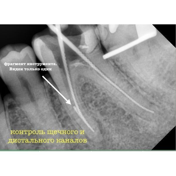 КЛКТ после лечения КЛКТ после лечения