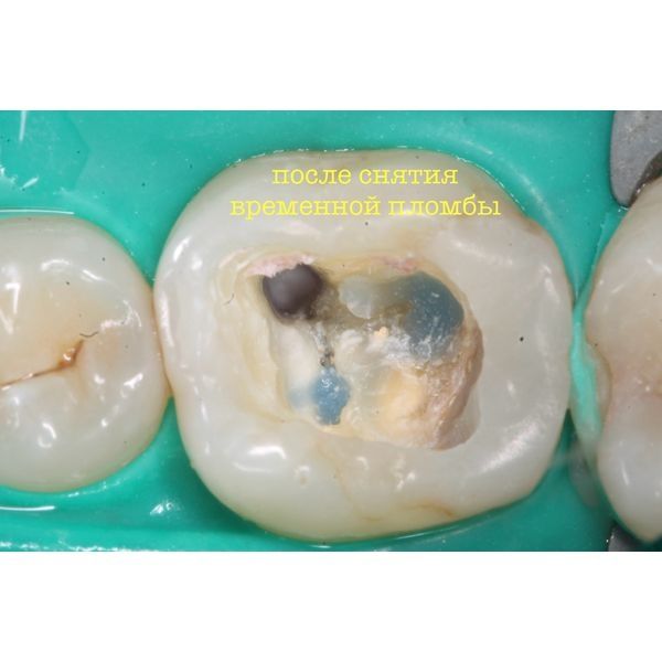 Полость зуба после удаления пломбы Полость зуба после удаления пломбы