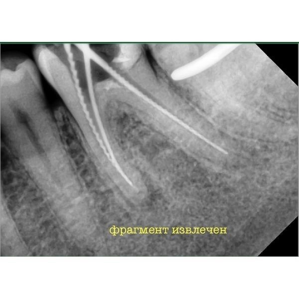 Рентгенография после первого этапа лечения Рентгенография после первого этапа лечения