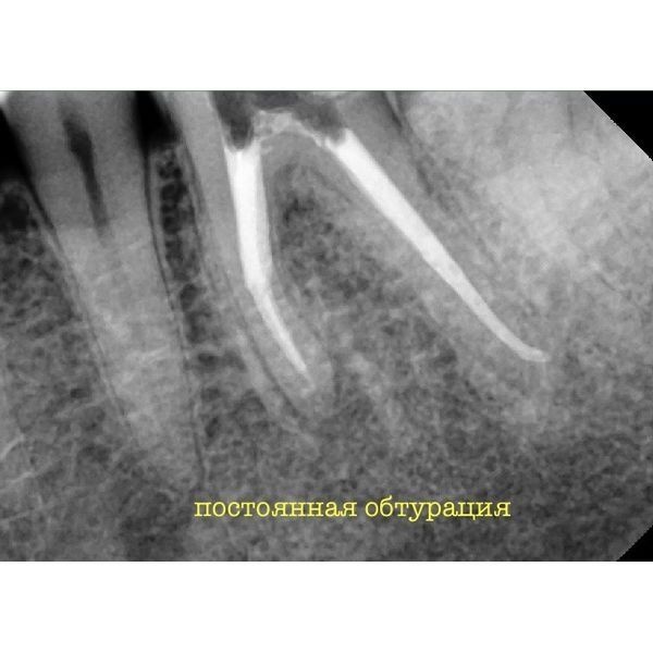 Пломбирование гуттаперчей Пломбирование гуттаперчей