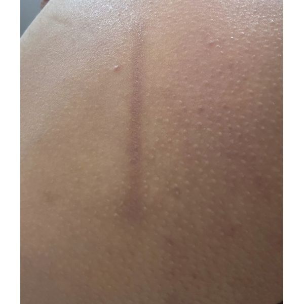 Рубец на правом бедре после лечения Рубец на правом бедре после лечения