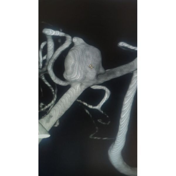 3D-ангиография до эмболизации аневризмы