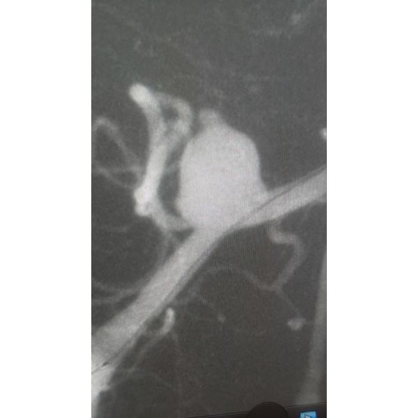 Ангиографическая картина до эмболизации аневризмы