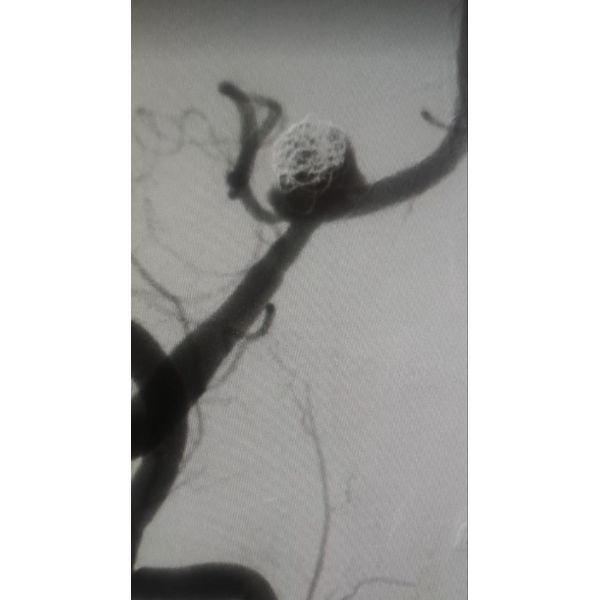 Ангиографическая картина после эмболизации аневризмы