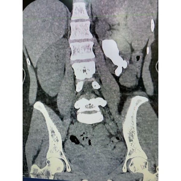 КТ почек до операции КТ почек до операции