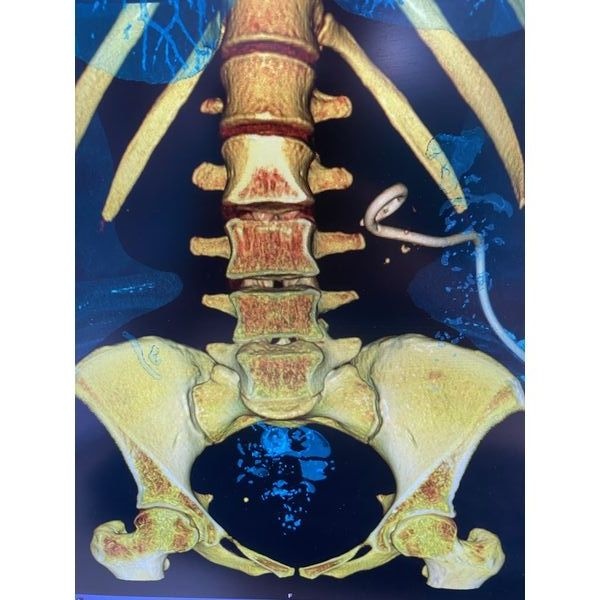 КТ почек после операции КТ почек после операции