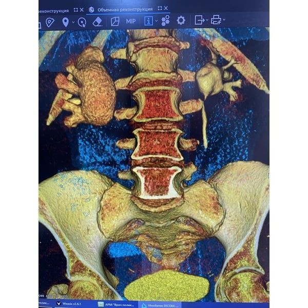 КТ почек до операции