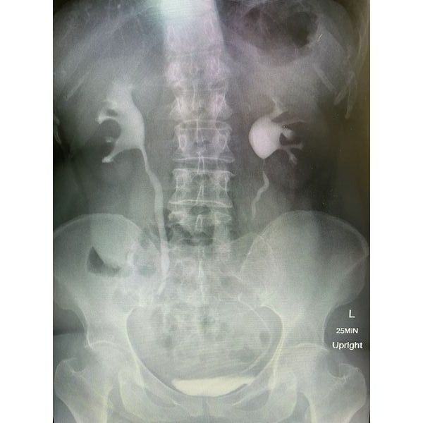 Экскреторная урография через 6 месяцев после операции