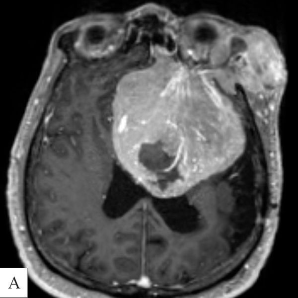 Снимок МРТ до операции