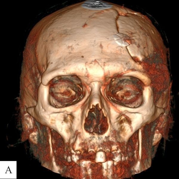 На снимке КТ-АГ до операции видна выраженная сосудистая сеть опухоли