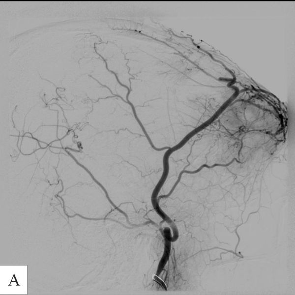 Ангиографический снимок показывает зону для эмболизации сосудов опухоли