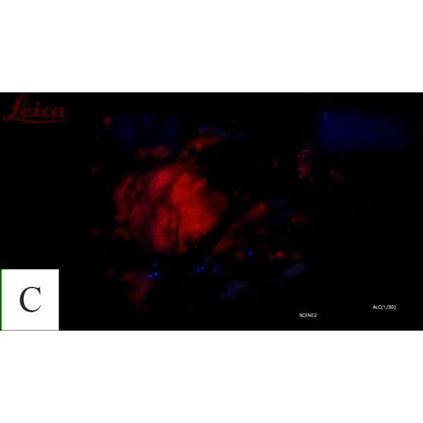 Флуоресцентная картина (свечение) опухоли во время операции