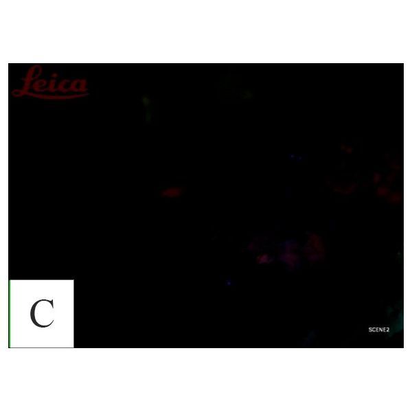 Отсутствие флуоресценции после проведения фотодинамической терапии