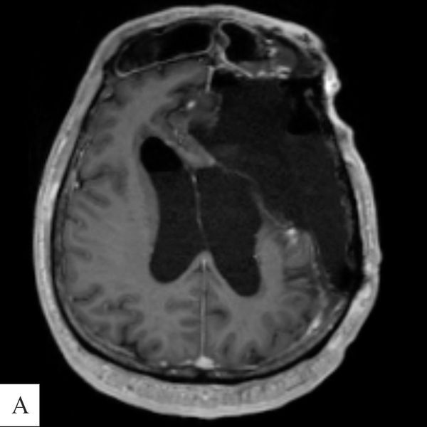 Снимок МРТ после операции: тотальное удаление опхуоли