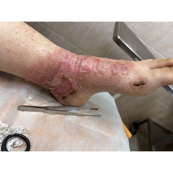 Перевязка через 3 недели Перевязка через 3 недели